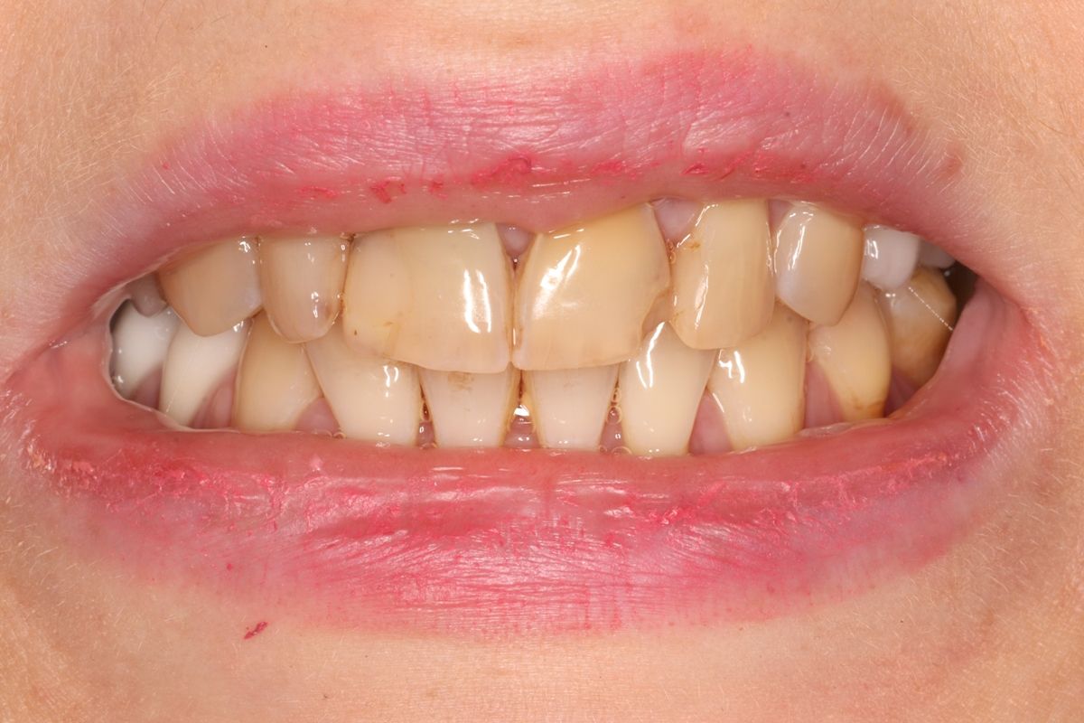 скол переднего зуба в клинике ТоталСтол