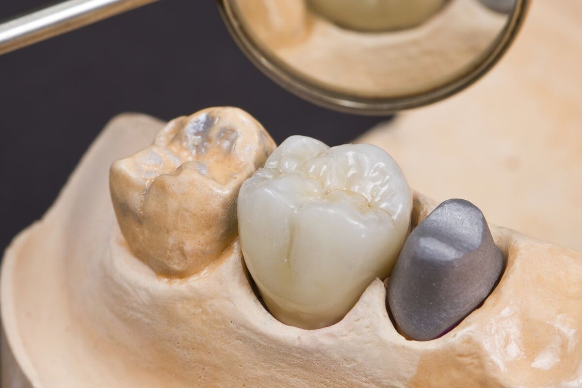 индивидуальное изготовление металлокерамических коронок в стоматологии ТоталСтом