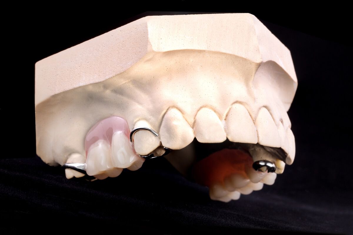 съемное протезирование в стоматологии ТоталСтом