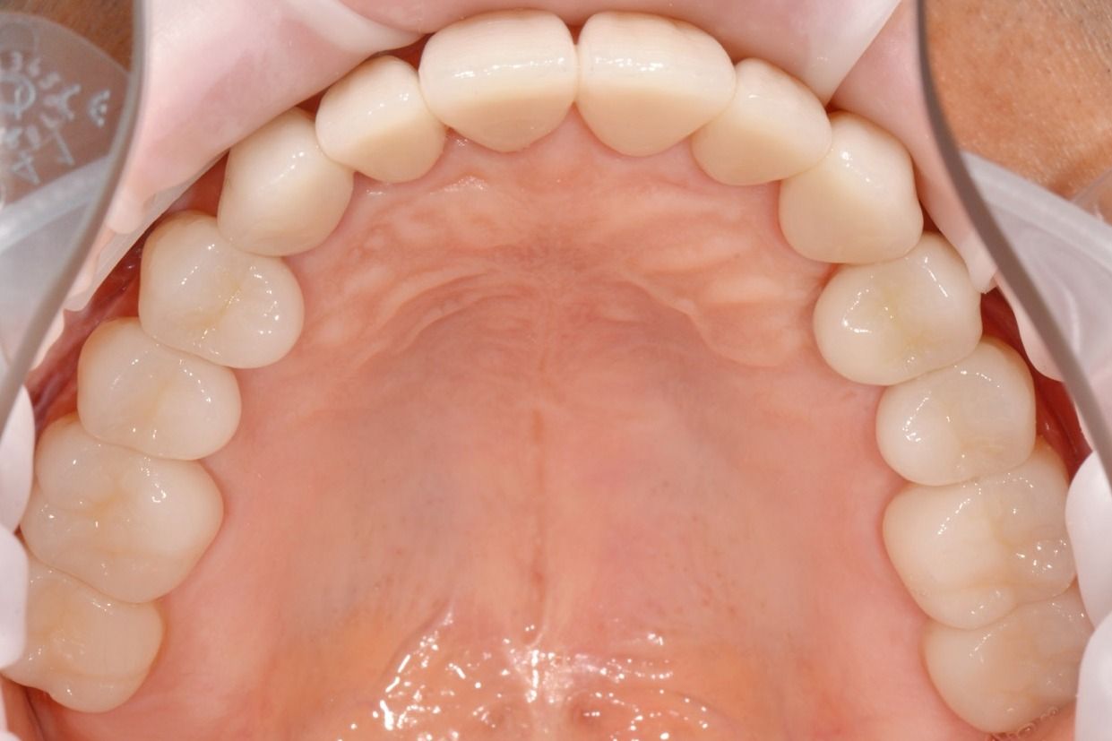 Установленные циркониевые коронки в стоматологии ТоталСтом