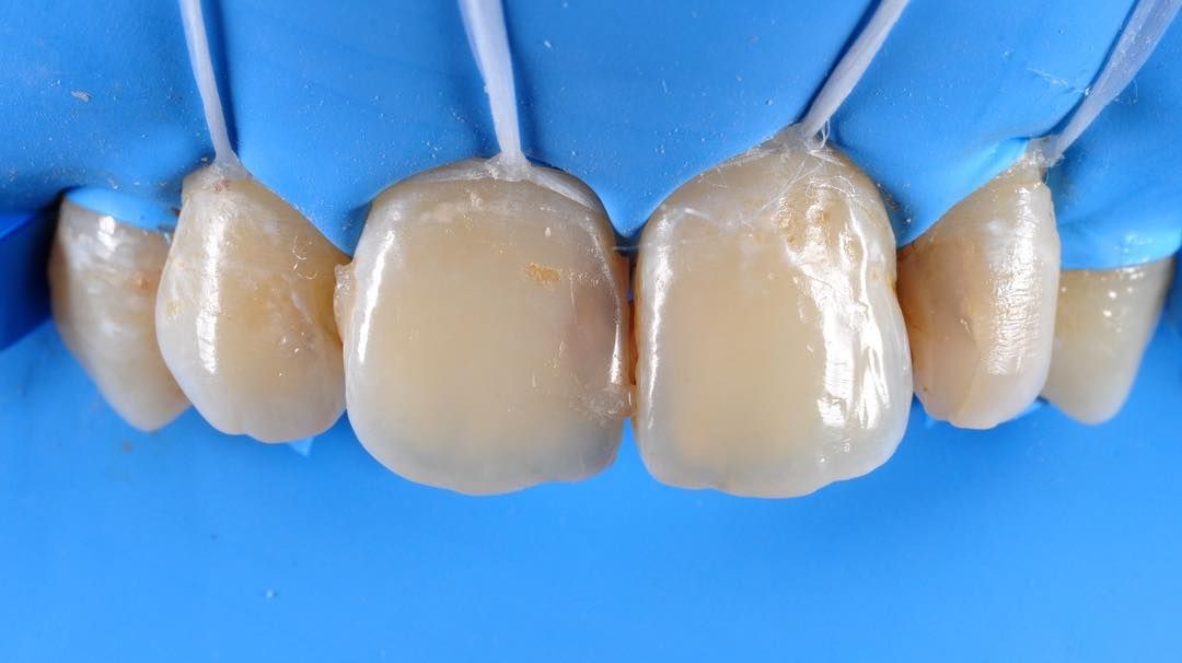 передние зубы изолированы перед лечением в стоматологии ТоталСтом
