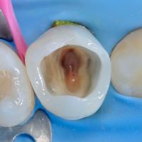 восстановление стенок зуба при эндодонтическом лечении в стоматологии ТоталСтом
