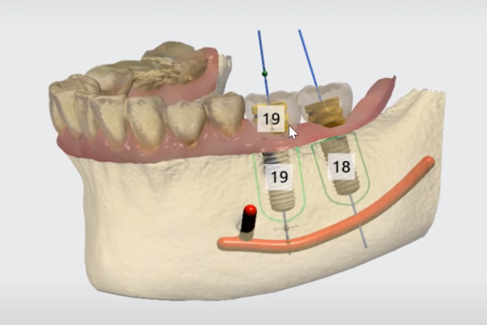планирование имплантации зубов в Спб