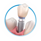 Имплантация зубов - стоматология ТоталСтом