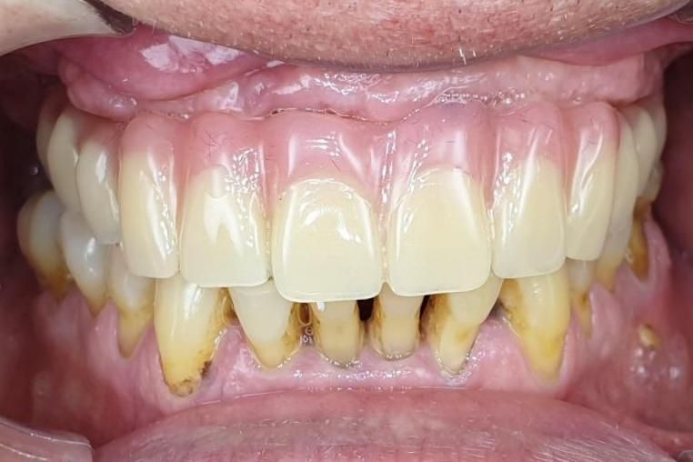 передний зуб после лечения кариеса в стоматологии ТоталСтом