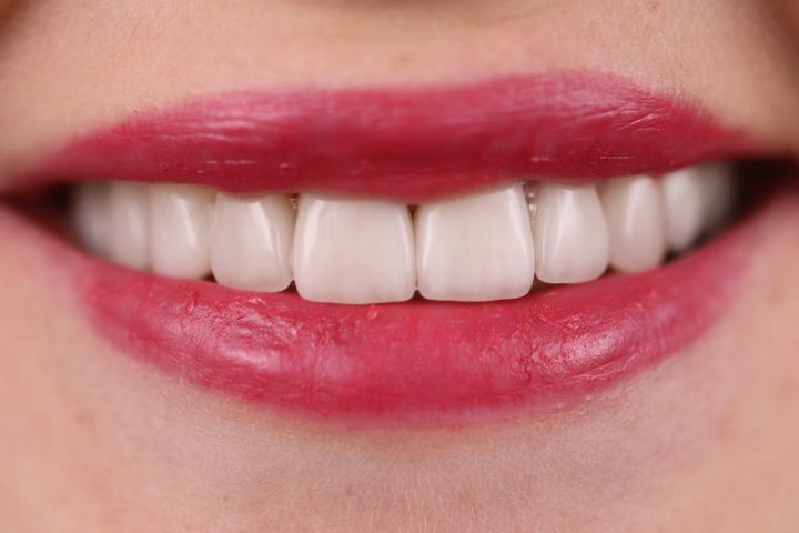 восстановление зубов керамическими коронками в клинике ТоталСтом
