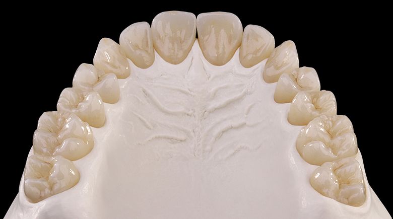 протезирование циркониевыми коронками про отсутствии зубов в клинике ТоталСтом