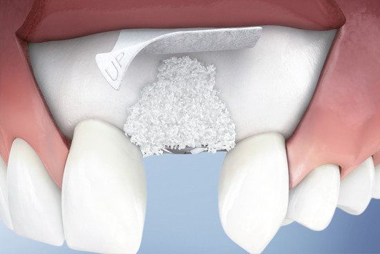 увеличение объема костной ткани в стоматологии ТоталСтом