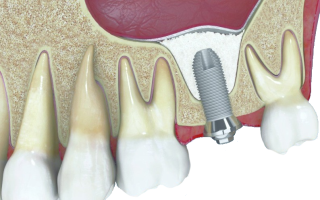 костная пластика в стоматологии ТоталСтом