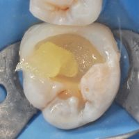 восстановление коронковой части зуба композитным материалом в стоматологии ТоталСтом