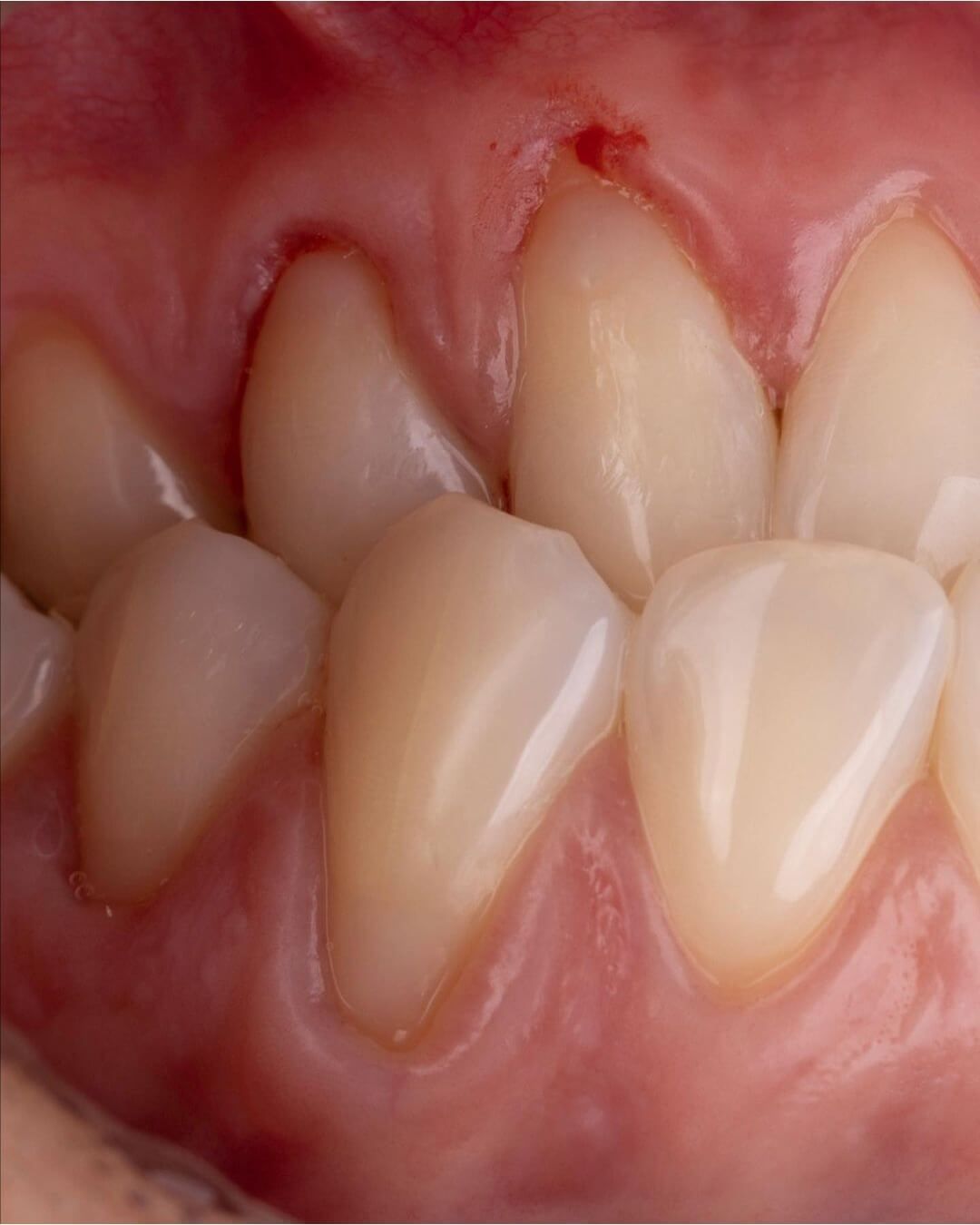 верхний и нижний клык после лечения пришеечного кариеса в стоматологии ТоталСтом