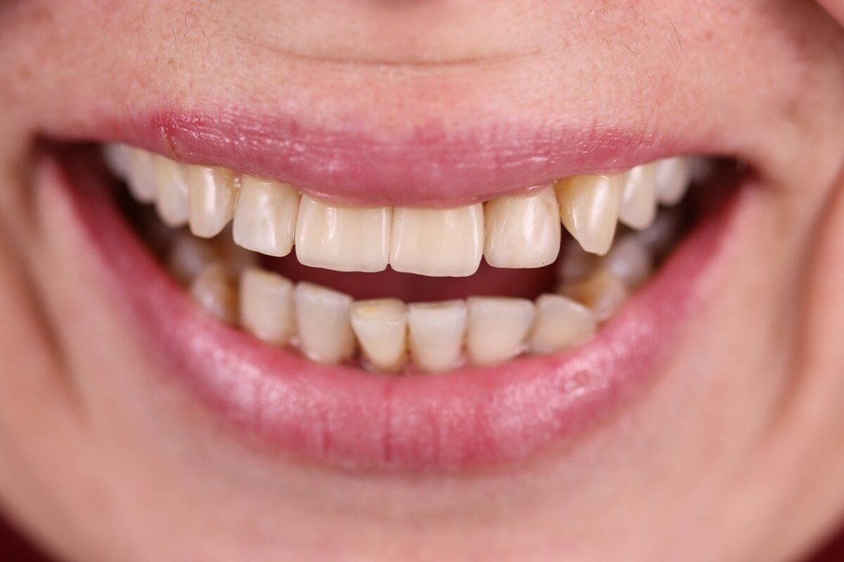 восстановление зубов циркониевыми коронками в клинике ТоталСтом