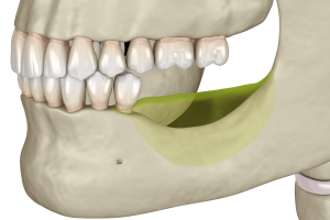 Пересадка костных блоков на нижней челюсти в ТоталСтом