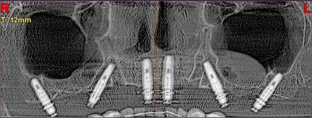 рентген верхней челюсти с позициями 6-ти имплантатов 