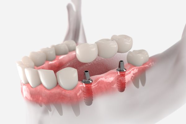Протезирование 3-х зубов